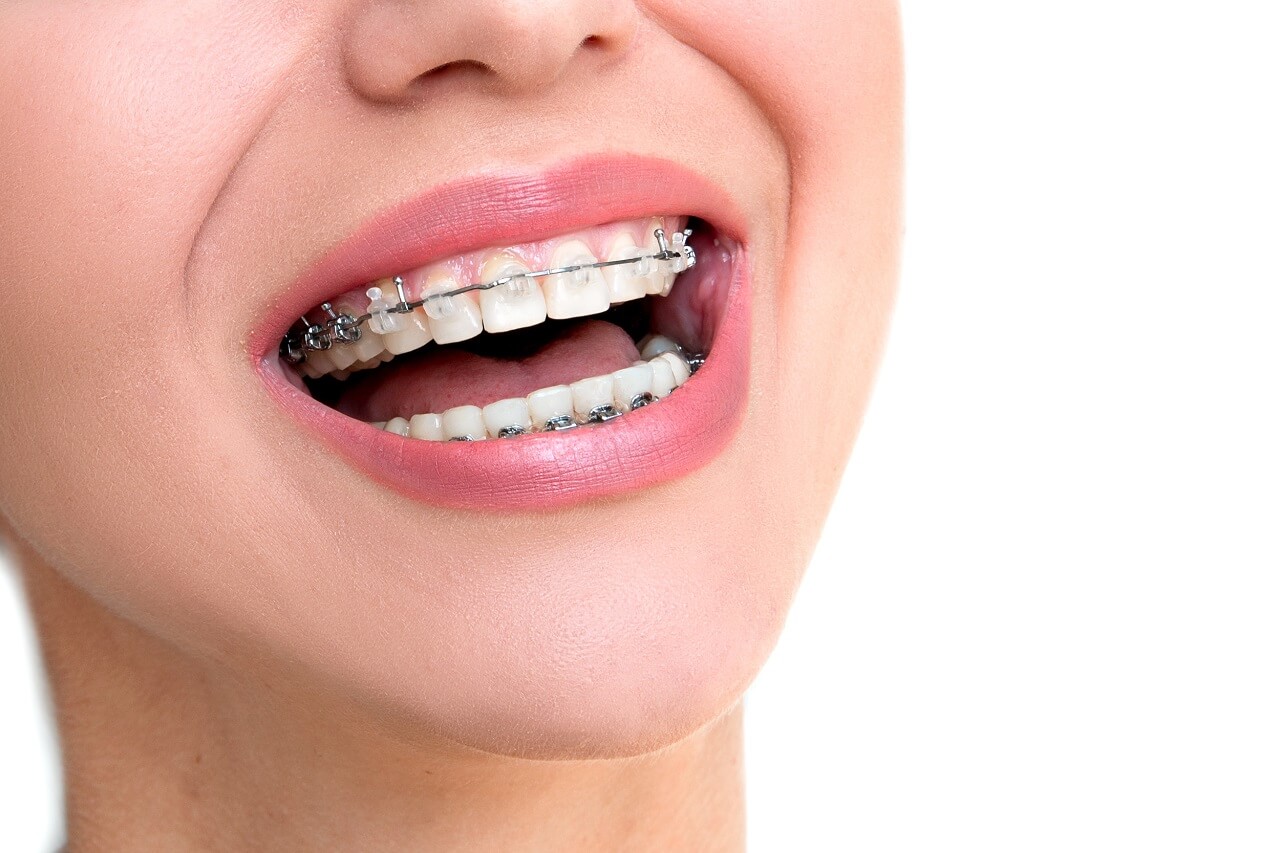 Orthodontics Treatment