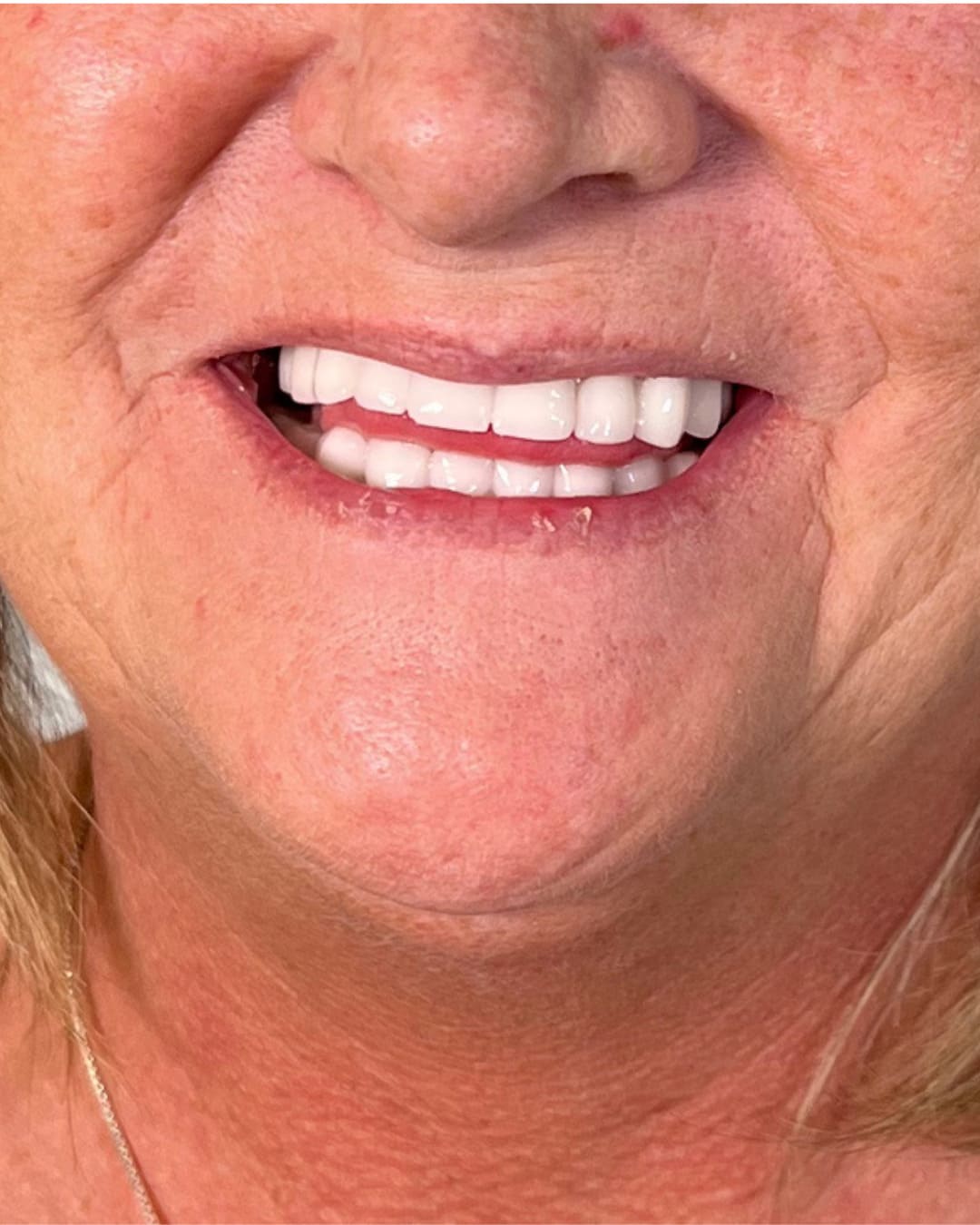 After Transformation