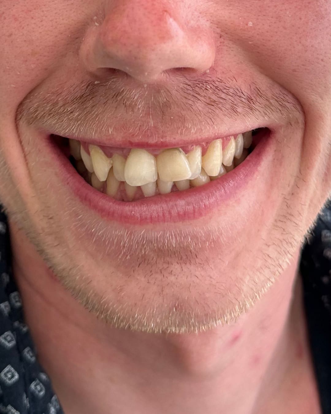 Before Transformation