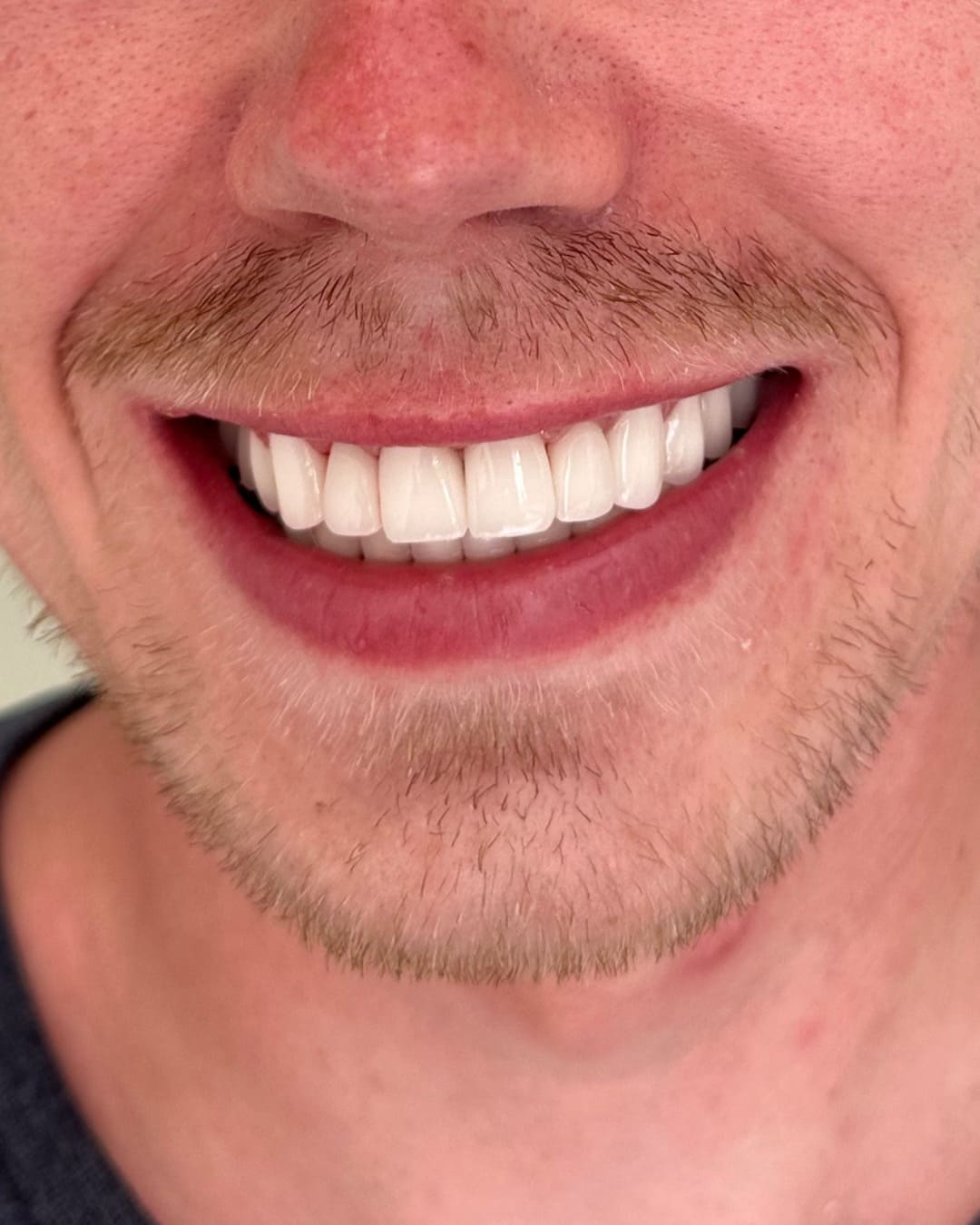 After Transformation